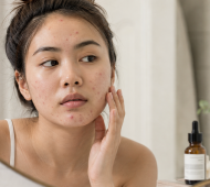 Da “đẩy mụn” và da bị kích ứng khác nhau như thế nào?