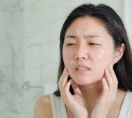 Kem chống nắng cho da mụn: Chọn sao để không bí da, không nặng mặt?